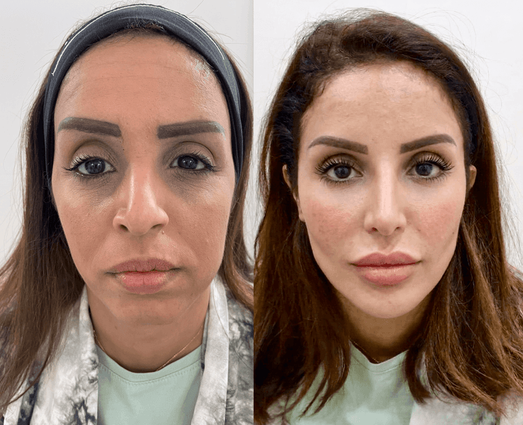 Face Harmonization (Case Study 1 Facial Harmonization)