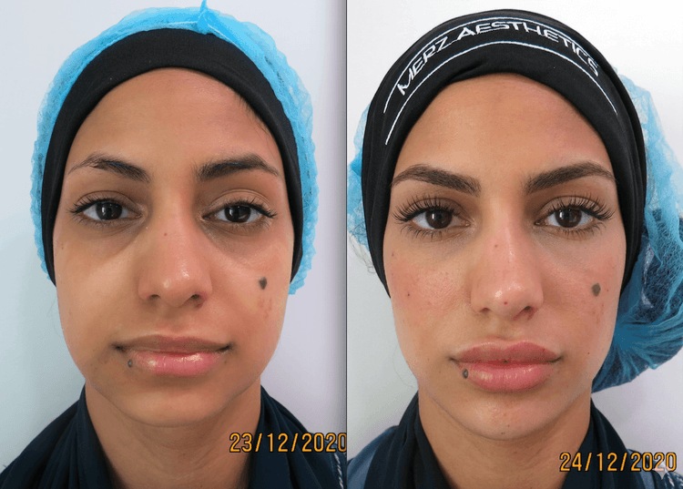 Face Harmonization (Case Study 3 Facial Harmonization)